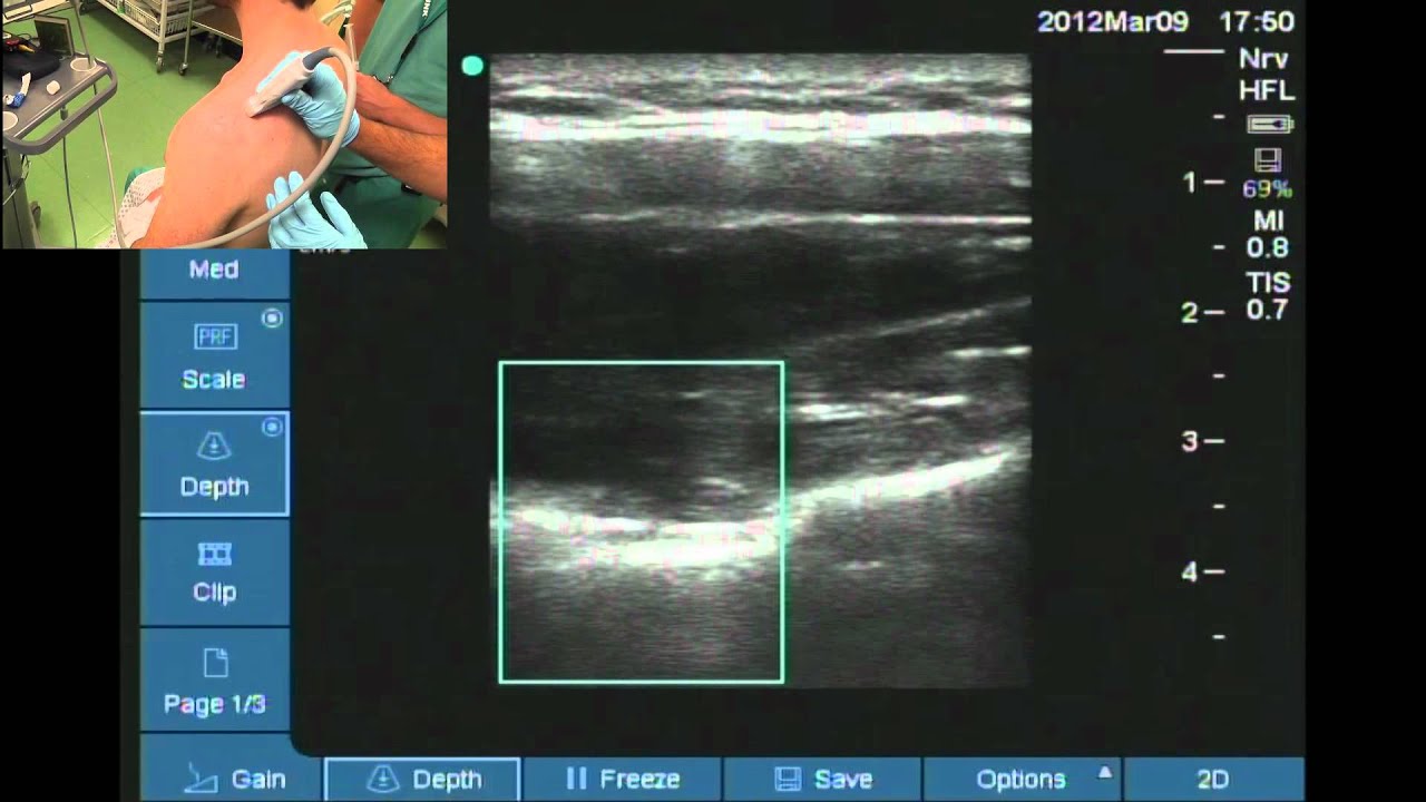 Suprascpular nerve block