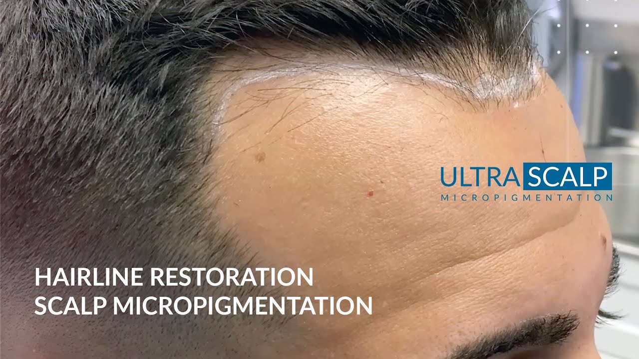 Hair Tattoo -  Front Hairline - Tampa Florida Scalp Micropigmentation - Hair Tattoo Tampa