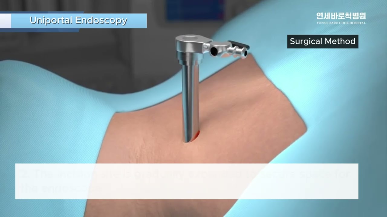 Uniportal Spinal Endoscopy: Explained in 3D