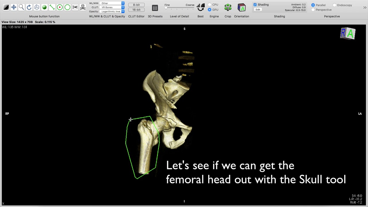 Pelvic fracture - How to delete the femoral head on Horos