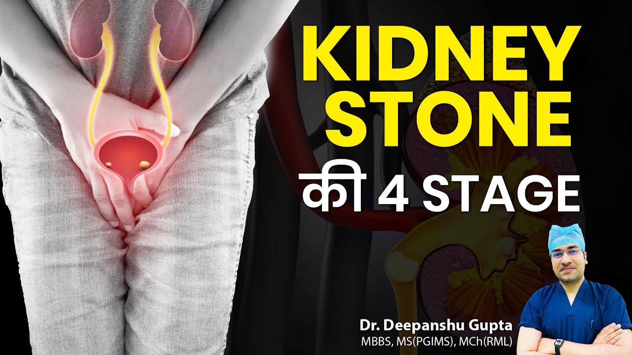Stone से छुटकारा — 4 Steps में समझिए पूरा प्रोसेस| Kidney Stone Treatment | Laser ON Stone GONE