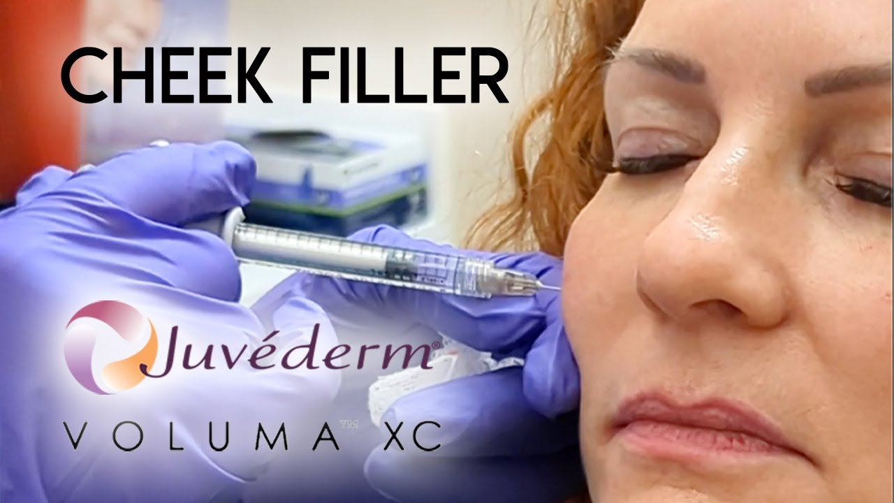 Cheek Filler with Juvederm Voluma