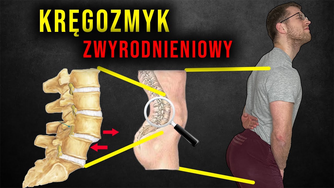 Ból kręgosłupa lędźwiowego |  KRĘGOZMYK a hiperlordoza