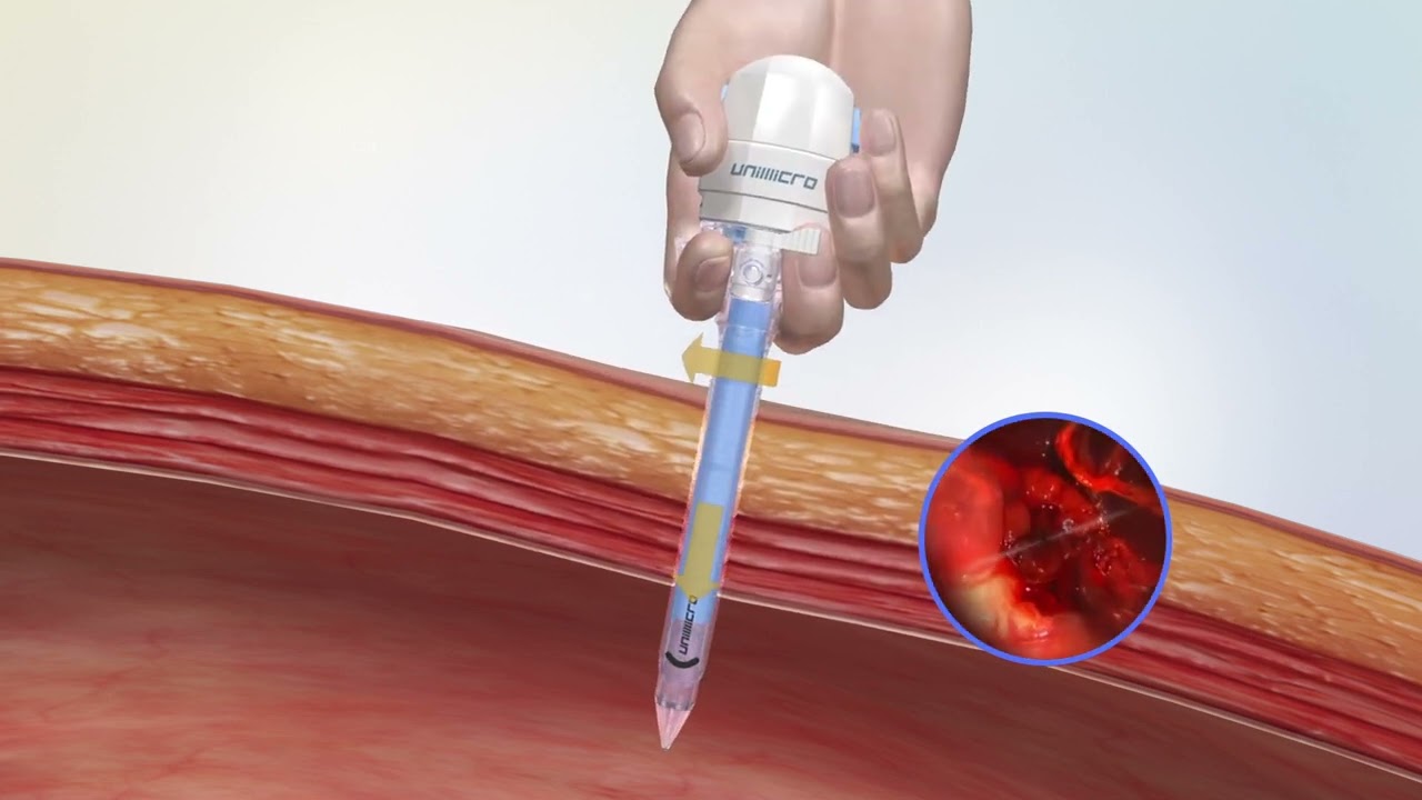 Unimicro&mdash;&mdash;A total Solution Supplier for Laparoscopic Instruments&mdash;&mdash;Trocar