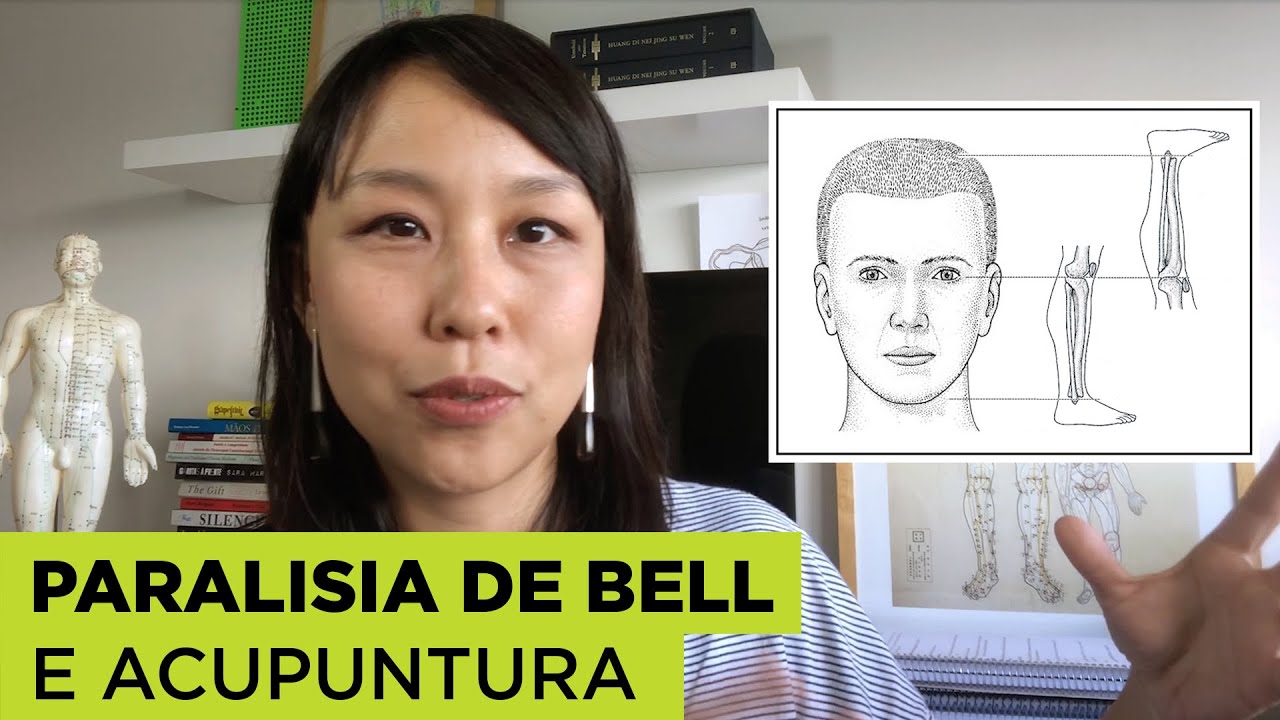 Como tratar Paralisia Facial com Acupuntura