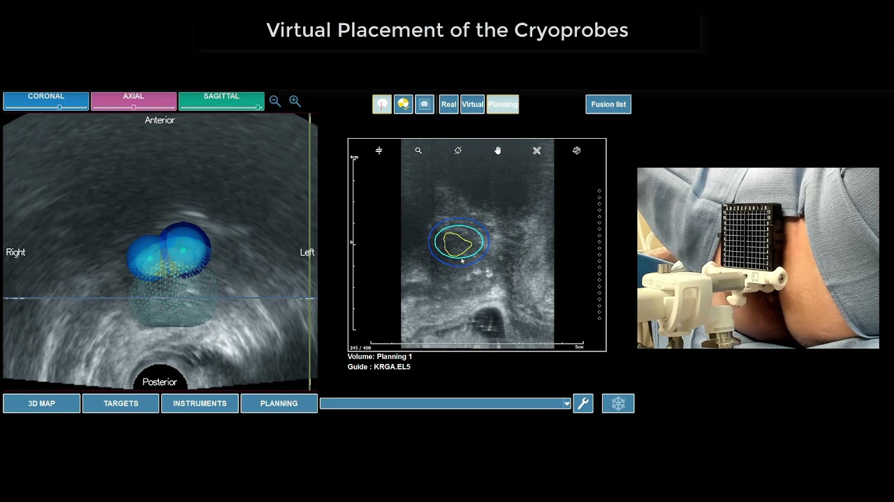 Focal Cryoablation of the Prostate with the KOELIS Trinity Platform