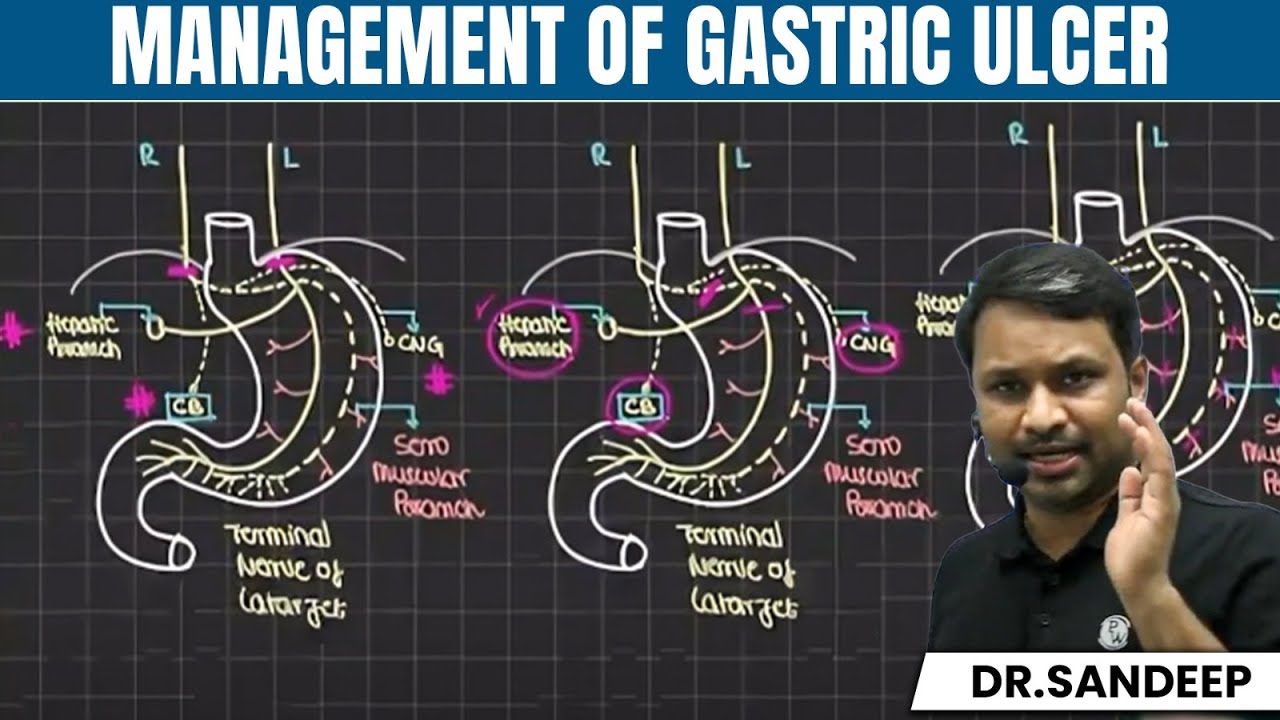 Management of Gastric Ulcer | Surgery | Bailey learned with Dr. Sandeep