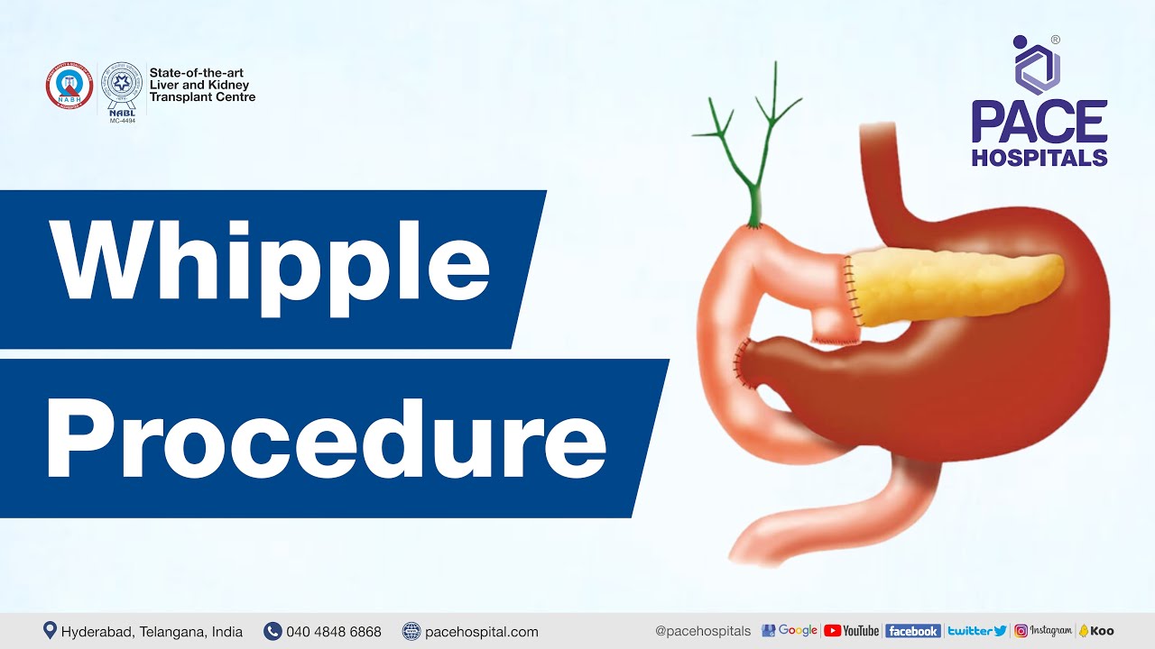 The Whipple Procedure | Indications, Steps, Success Rate and Complications