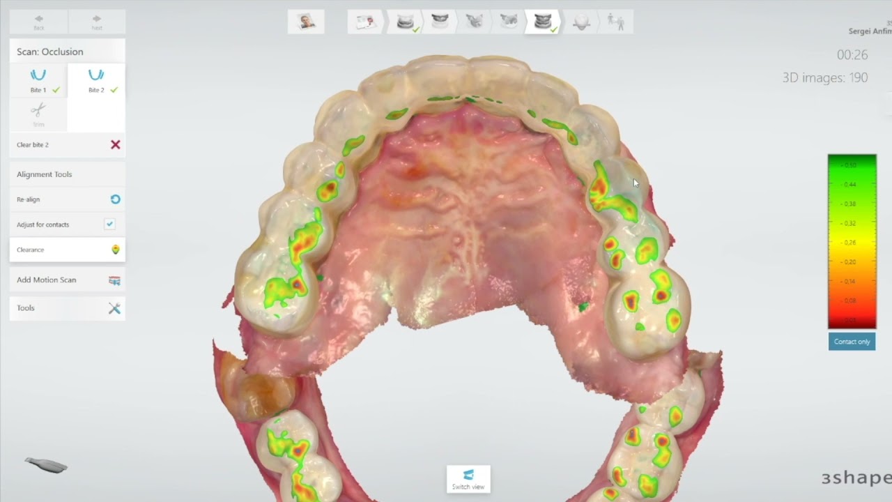 3shape Full Arch Implants Protocol