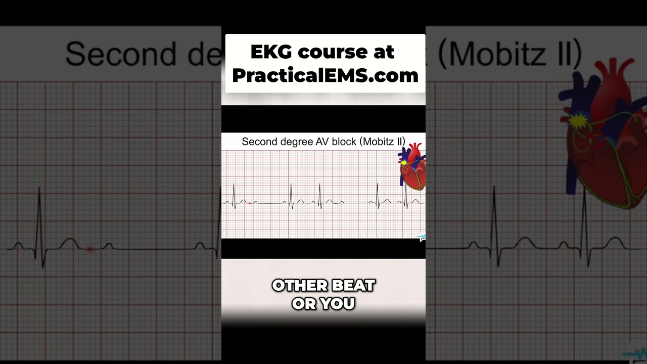 Mobitz II EKG: Know This Heart Block Before It's Too Late! #shorts