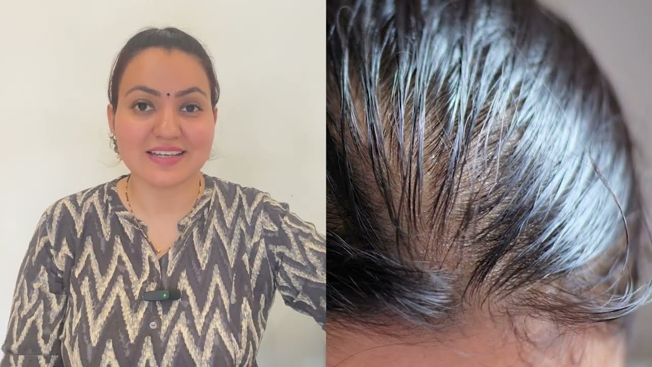 30 Days Hairline Growth Challenge : Grow Receding Hairline, Bald Patches Thick Long Hair❤️