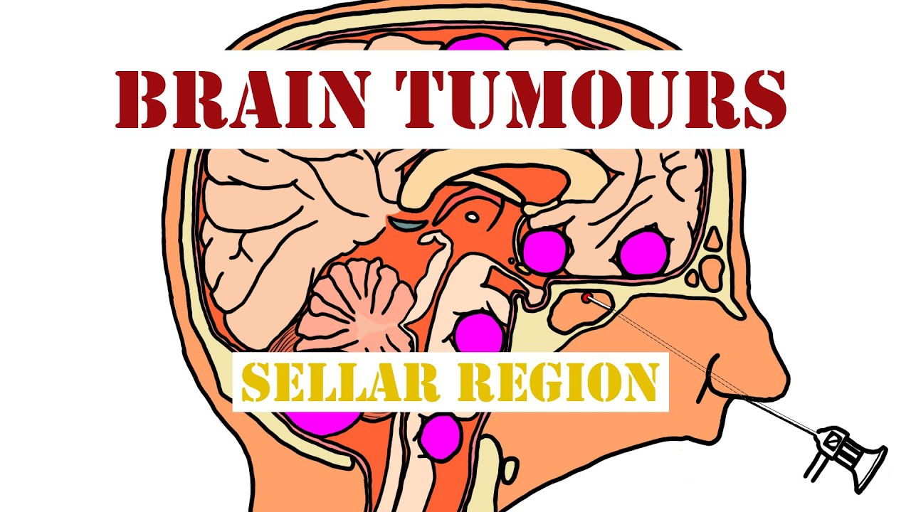 Tumours of the Sellar Region