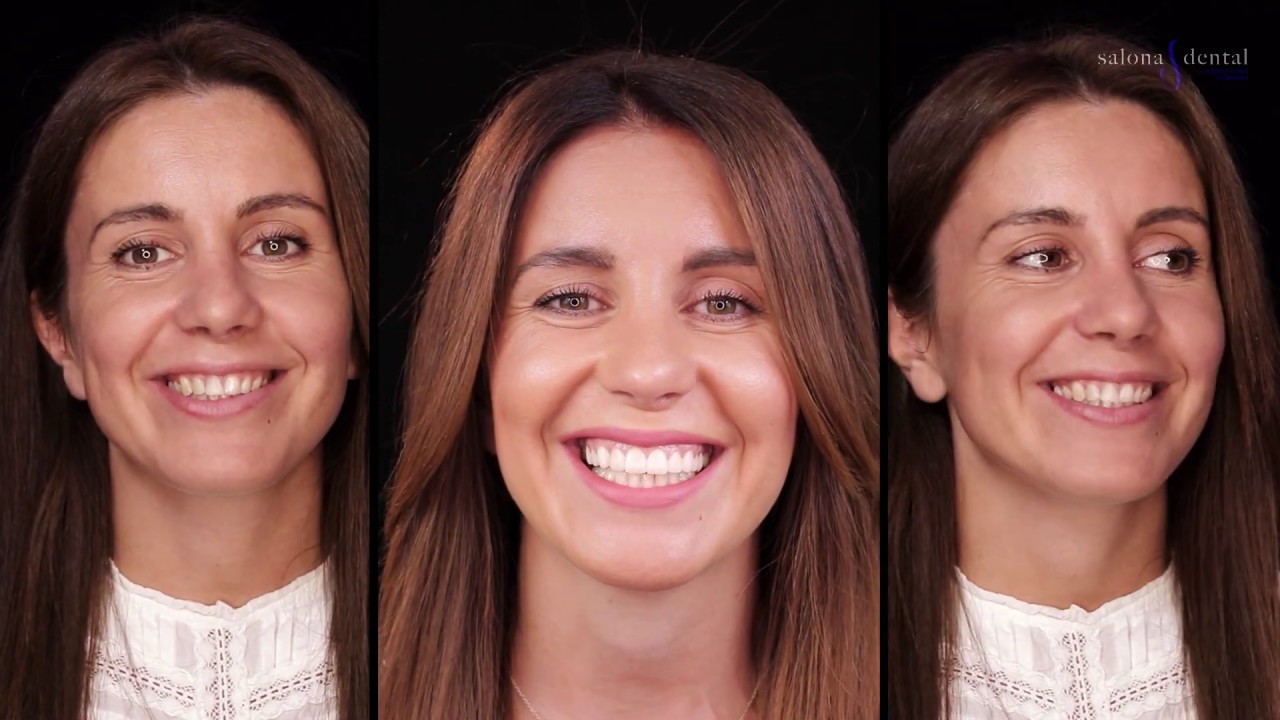 Salona Dental Makover 6 - Cirkon keramičke krunice