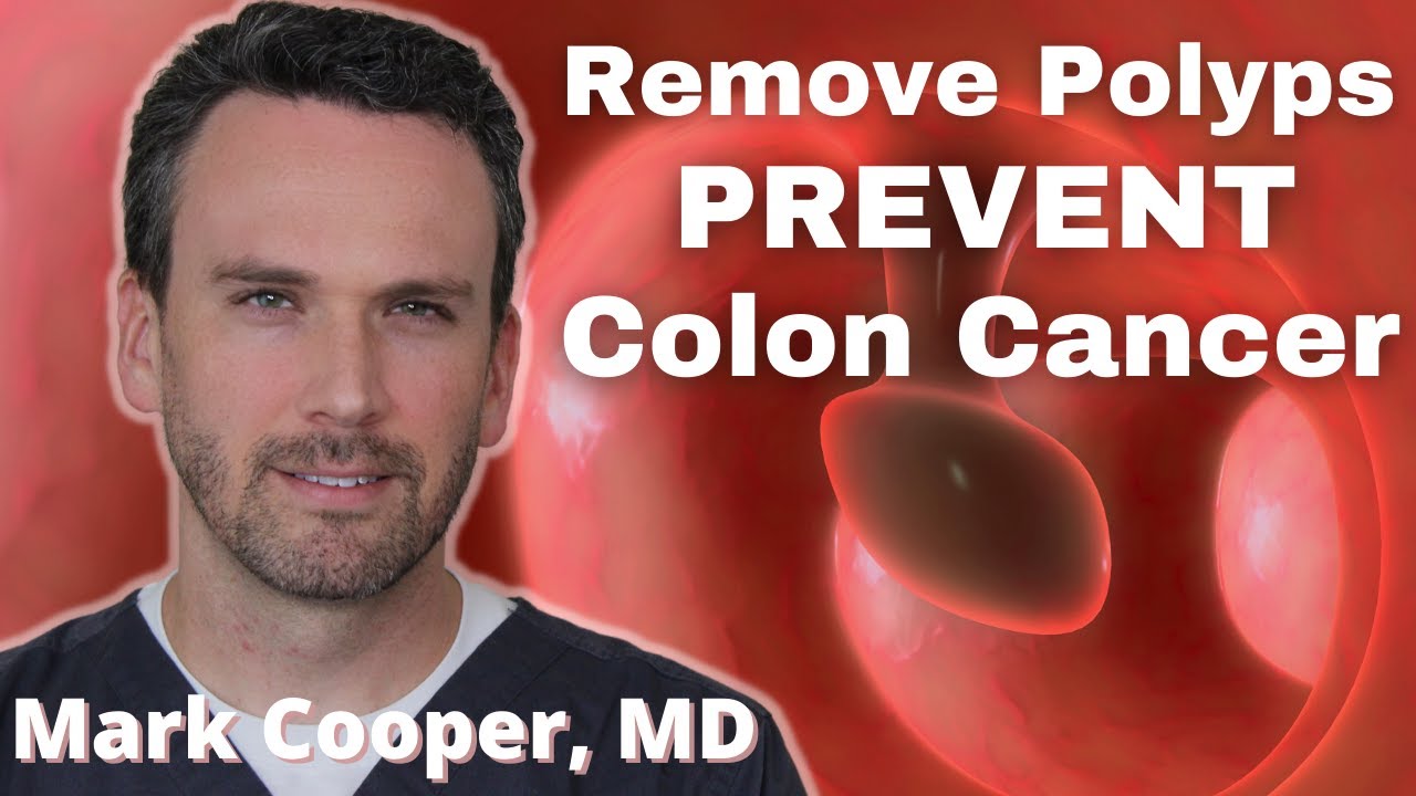 What Happens If You Have Colon Poylps?