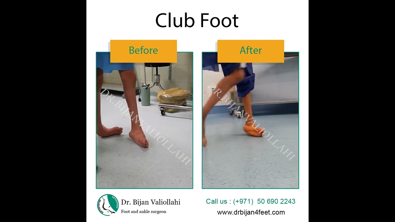 Club foot