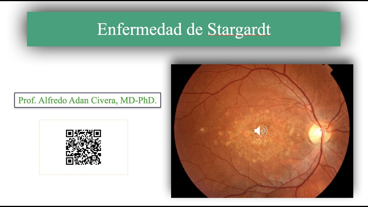 Enfermedad de Stargardt.