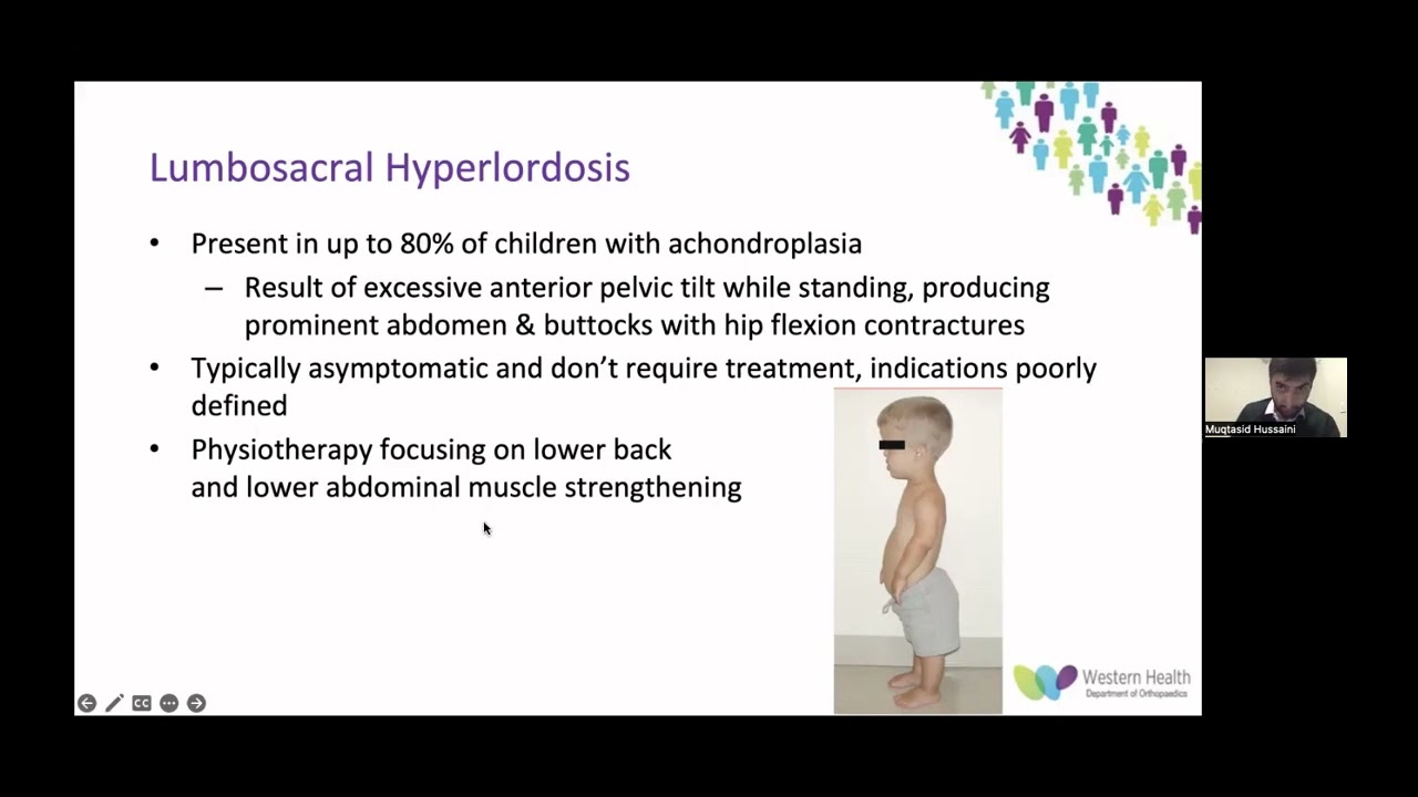 OrthoFracs Achondroplasia Summary by Dr Muqtasid Hussaini