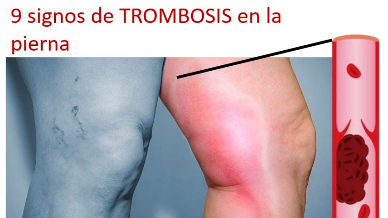9 señales de que tu dolor de pierna es un trombo
