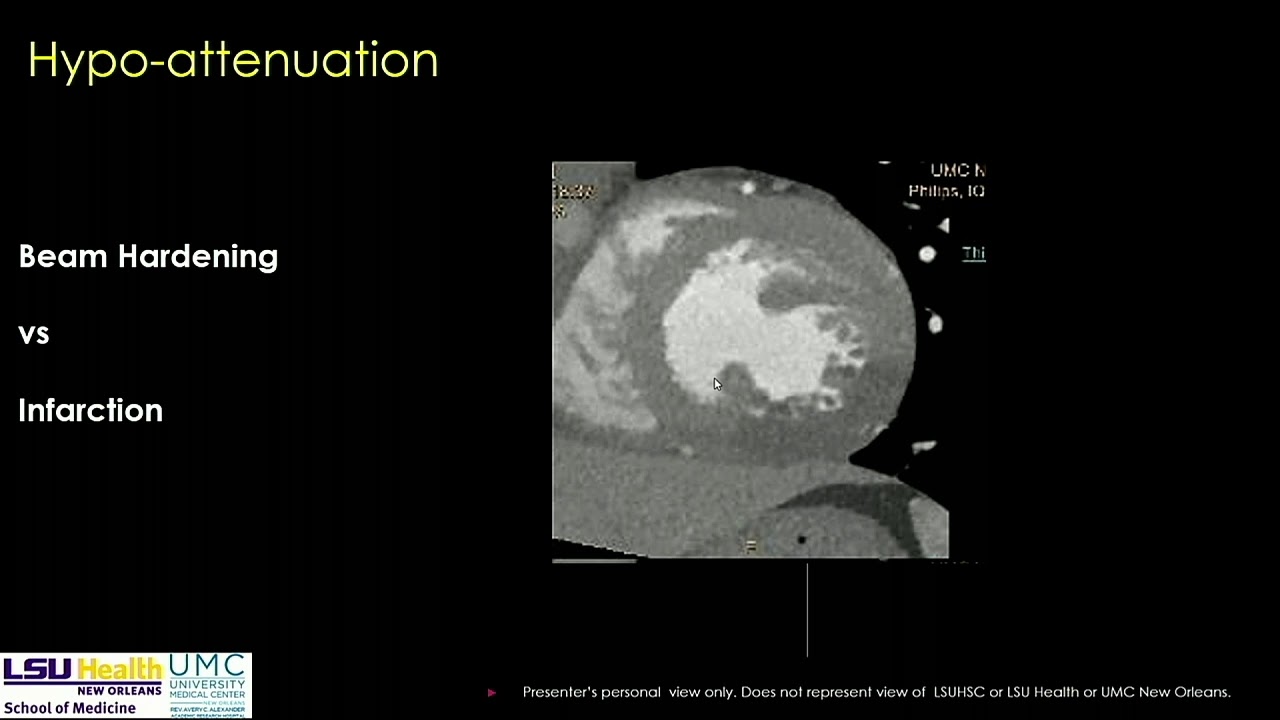 The Impact of IQon Spectral CT on Cardiac CT: Detector-based Spectral CT Cardiac Cases.