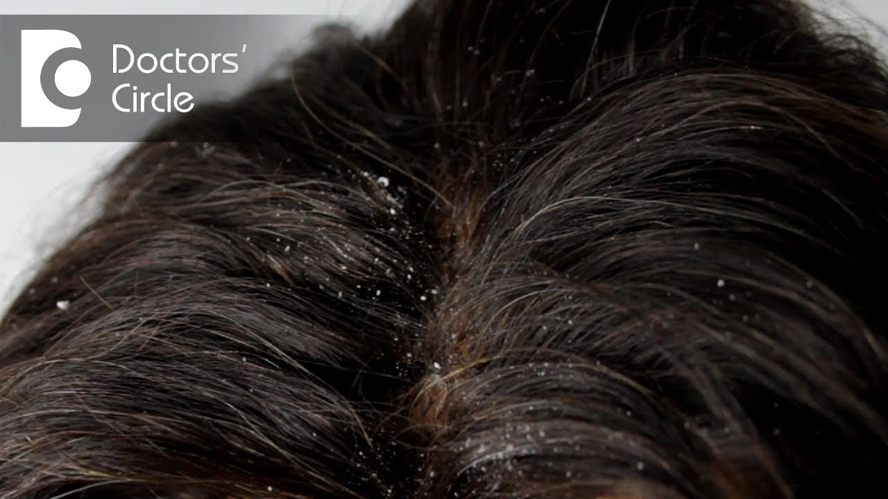 How to solve Dandruff problem? - Dr. Sudheendra Udbalker