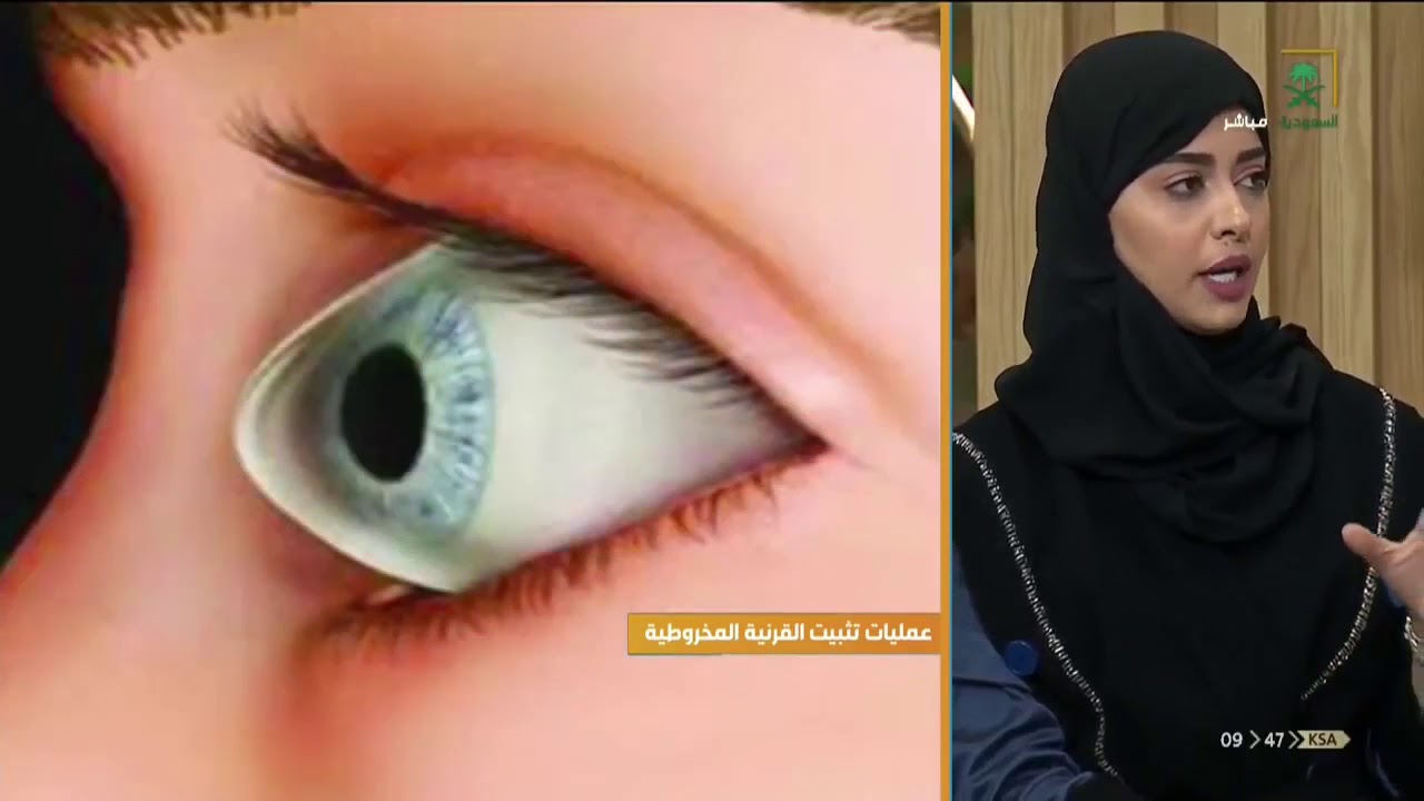 عمليات تثبيت القرنية المخروطية مع د. طراد القاضي - استشاري ليزك وقرنيه والماء الابيض.