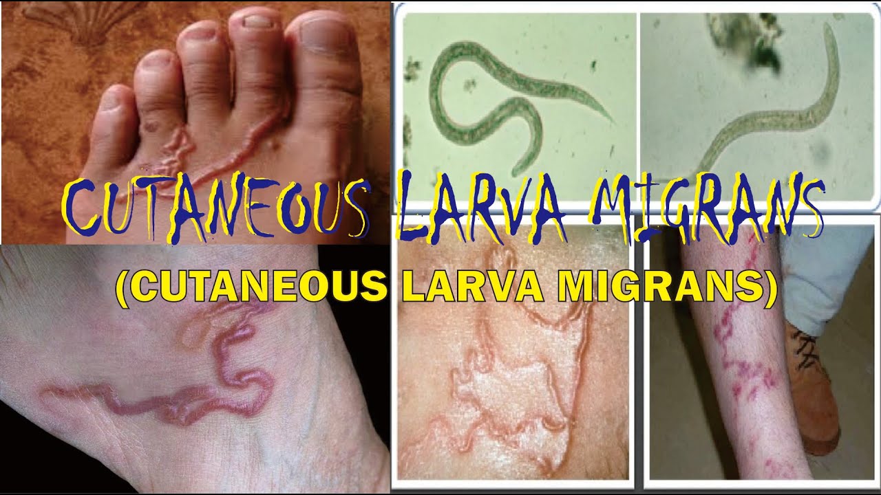 CUTANEOUS LARVA MIGRANS, Definisi, Penyebab, Gejala, Pengobatan, Komplikasi & Pencegahan