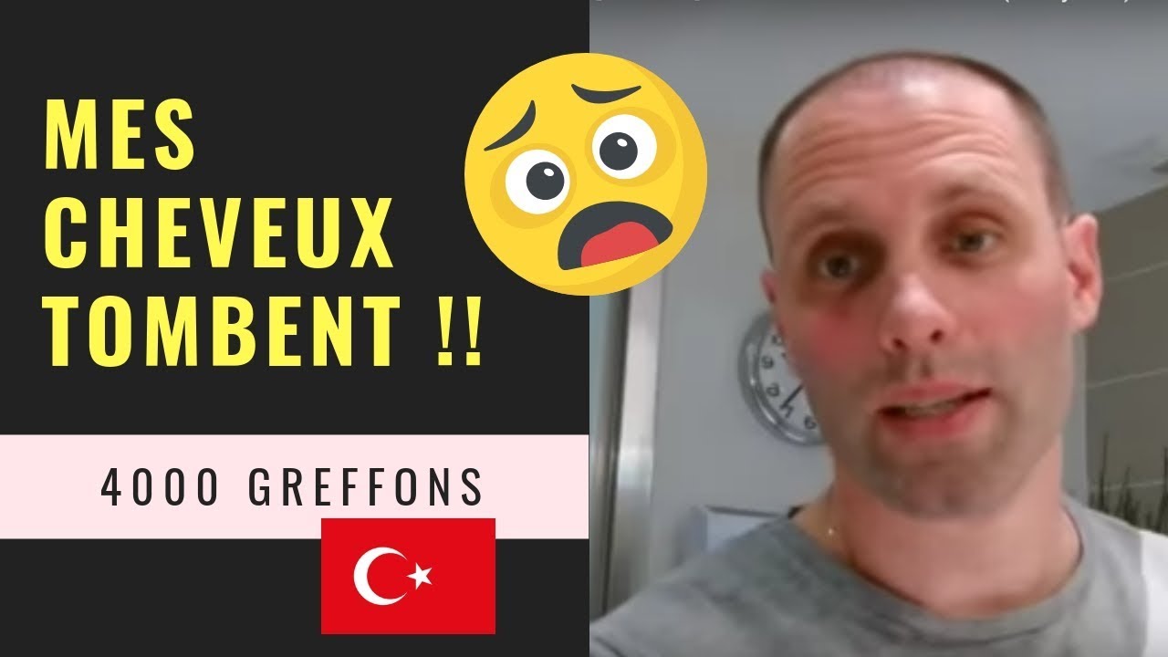 Greffe de cheveux FUE en Turquie [Vidéo 7] - Mes cheveux tombent (+15 jours)- 4000 Greffons