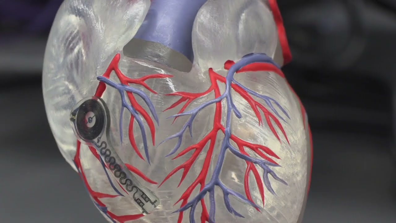 Dissolving pacemaker talks to body sensors, knows when to pace