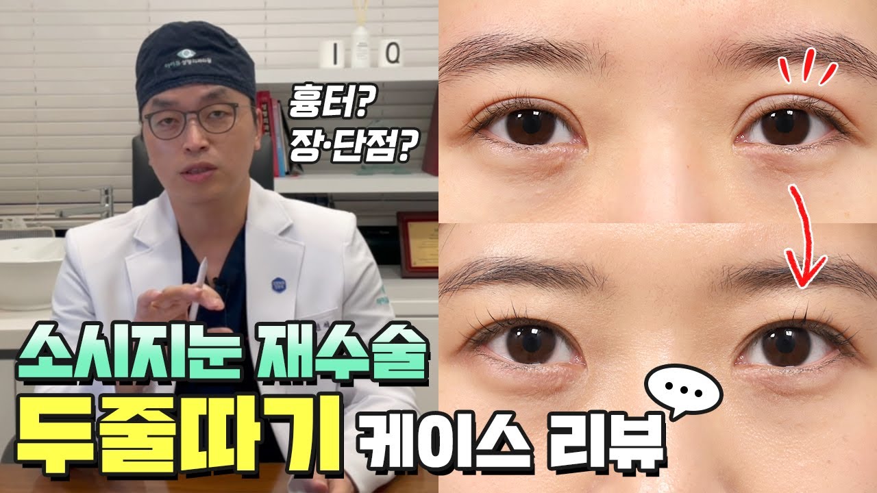 소세지눈 재수술 두줄따기 방법의 여러 케이스 분석, 장단점, 흉터, 오해 총정리