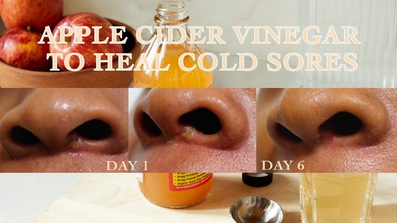 Apple Cider Vinegar to Heal Cold sores 🍎🧊 How To Quickly Treat Breakouts  ☑️ + Stress Triggers 2022
