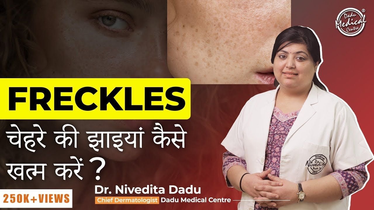 Freckles kyu hota hai? | फ्रेकल्स और दाग धब्बे का ईलाज | Best Skin Specialist in Delhi | Dr.Nivedita