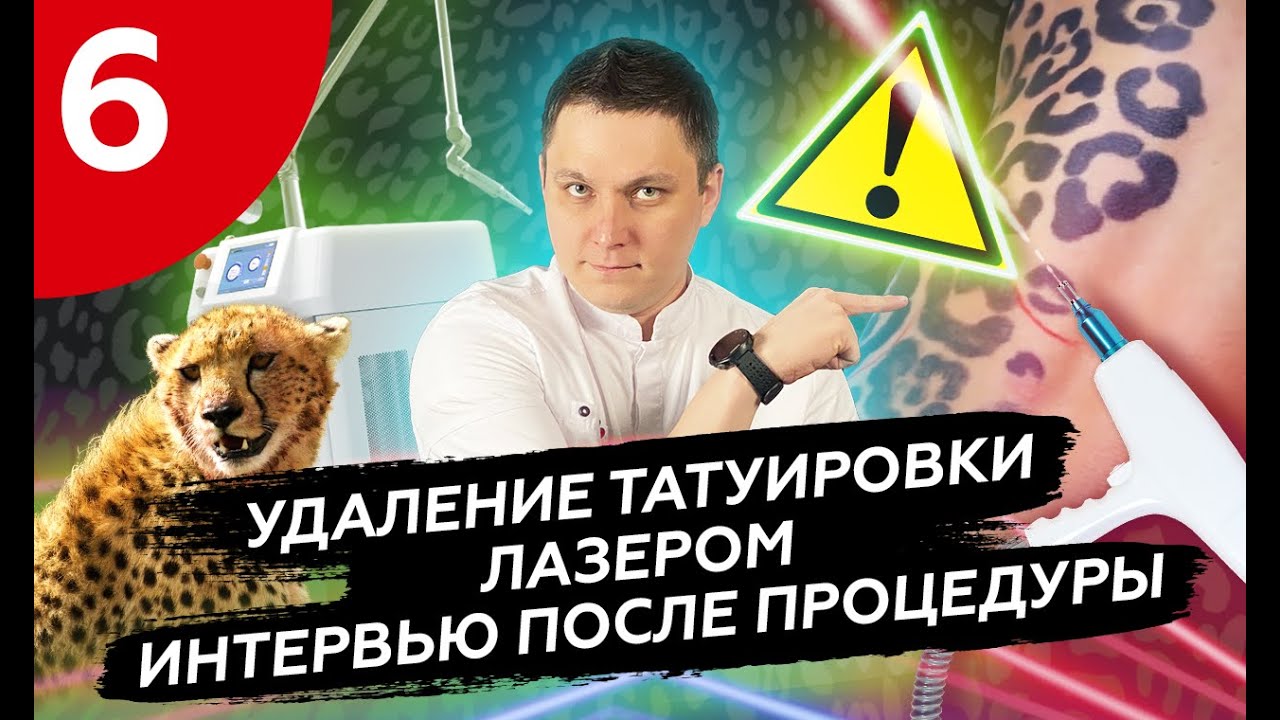 УДАЛЕНИЕ БОЛЬШОЙ ЛЕОПАРДОВОЙ ТАТУИРОВКИ #удалениетату #удалениетатуростов