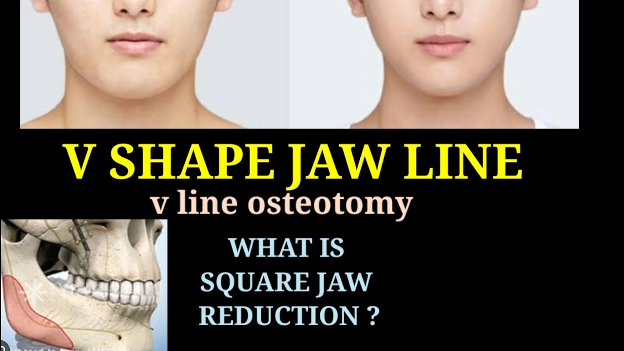 V SHAPE JAW LINE SURGERY INDIA INDORE MUMBAI DELHI HYDERABAD BANGALORE KOLKATA LUCKNOW AHMEDABAD