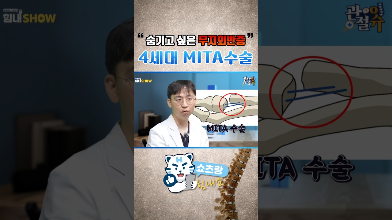 무지외반증 4세대 MITA수술