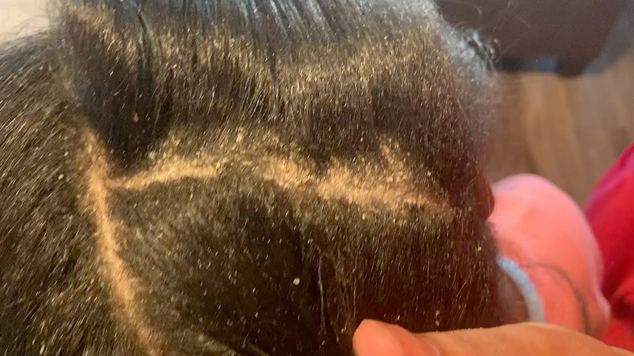 Satisfying Dandruff Scratch #2💆🏽&zwj;♀️
