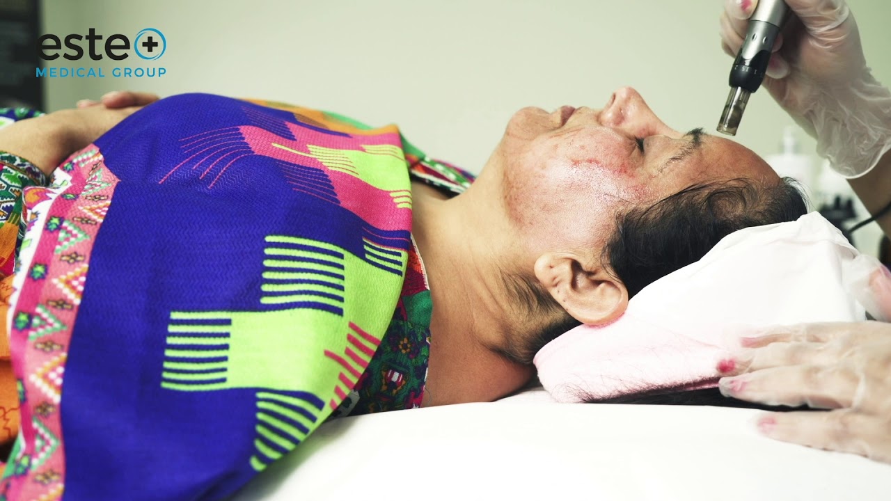 What Is a Dermapen Treatment? | Este Medical Group | Skincare Tips