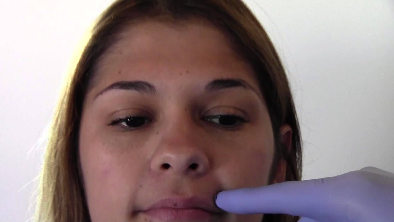 Botox Injection Demonstration, Reduce Bunny lines & Facial Wrinkles