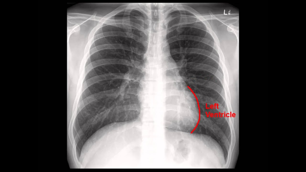 Chest X-Ray (CXR) Analysis in a Nutshell