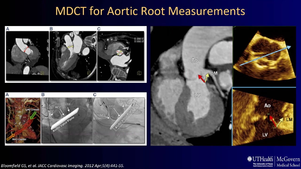 Echocardiography for Aortic Stenosis in the TAVR Era