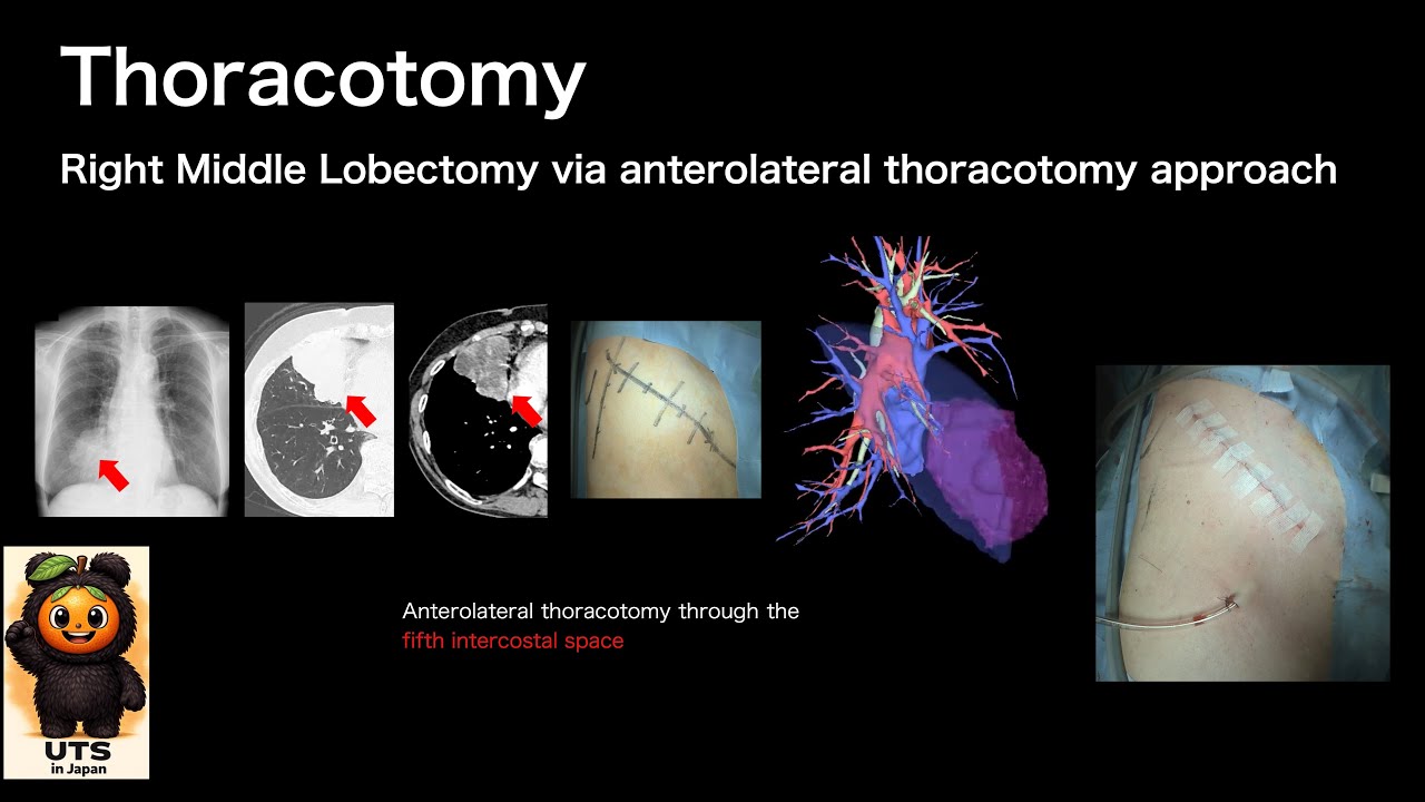 【#161】Thoracotomy, right middle lobectomy via anterolateral thoracotomy approach
