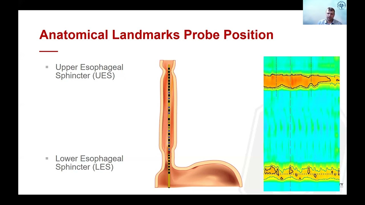 Manometry 101: What is Manometry? Evolution, How it Works and How it`s Performed