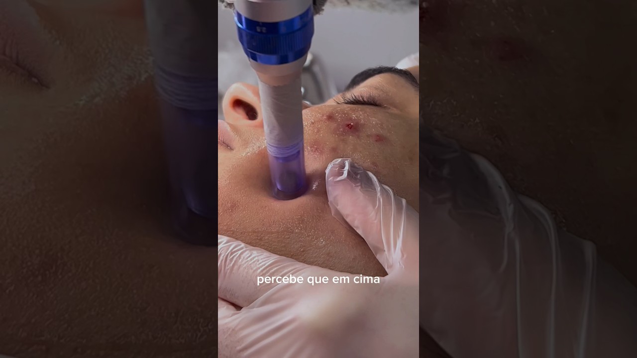 #microagulhamento #retinol