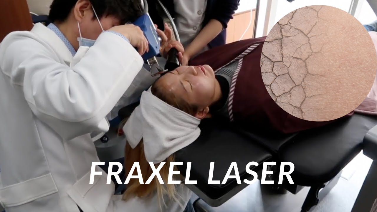 Fraxel Laser Treatment in Korea ft Chen and Peyton | Seoul Guide Medical