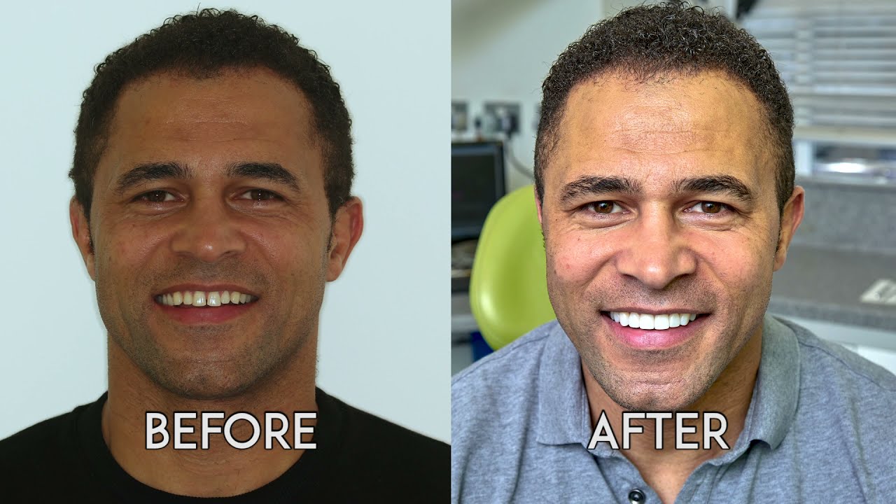SmileFast Veneers at Farsley Dental Practice
