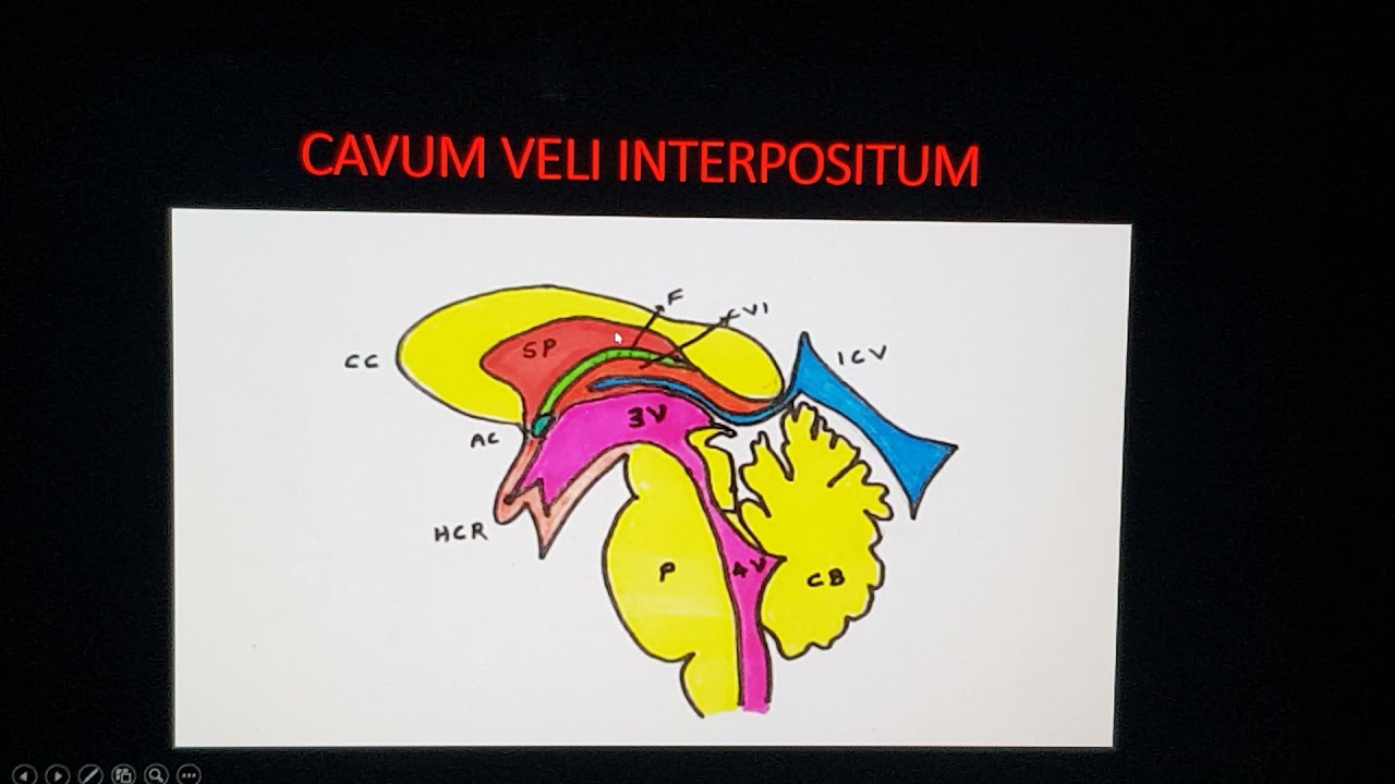 CYST OF FETAL CAVUM VELI INTERPOSITI TEACHING BY DR PRADEEP UNDER REFER SERIES www.mediknit.org