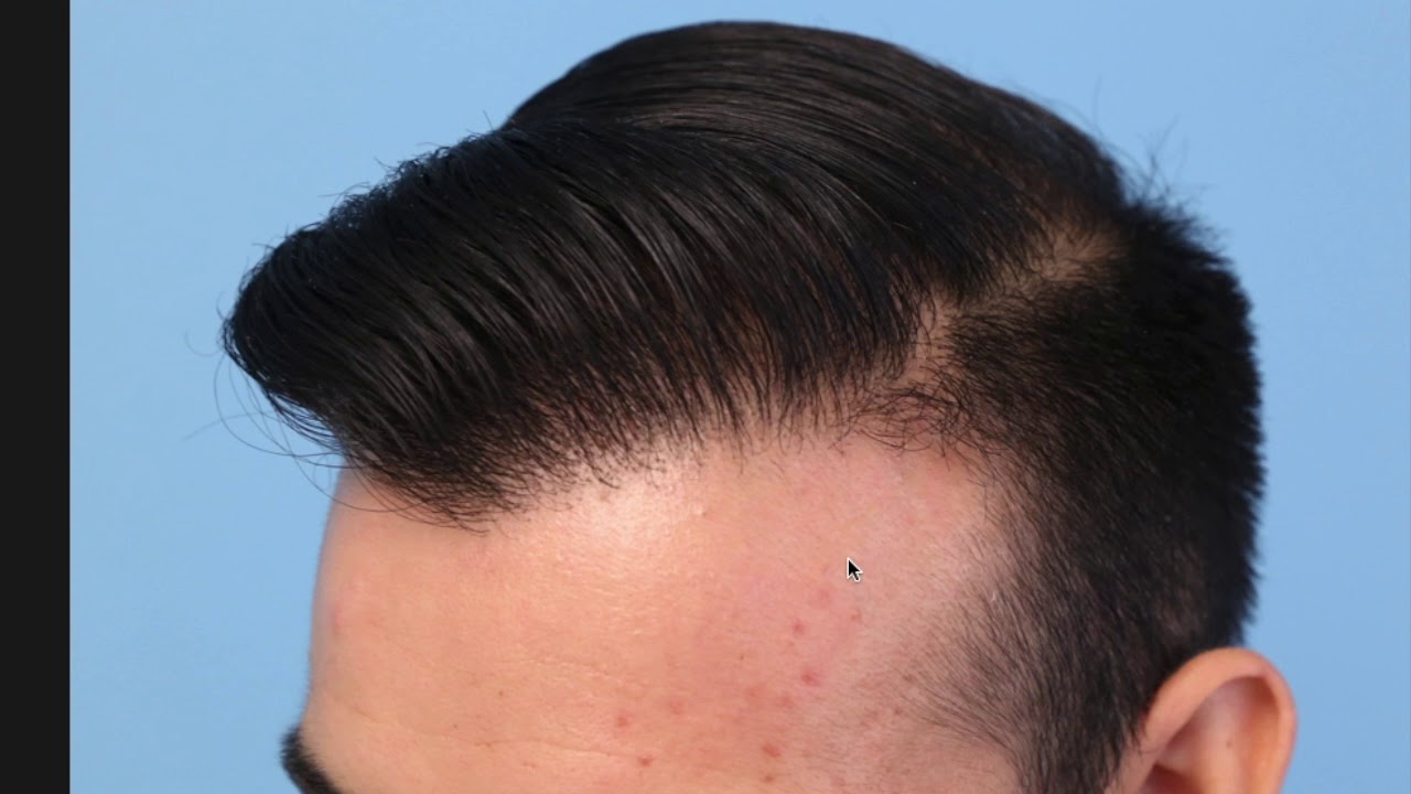 My Hair Loss Journey