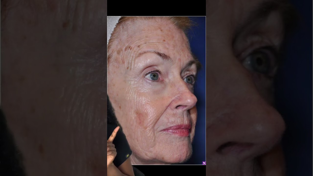 Photoaging: The Effects of Sun Exposure on Skin