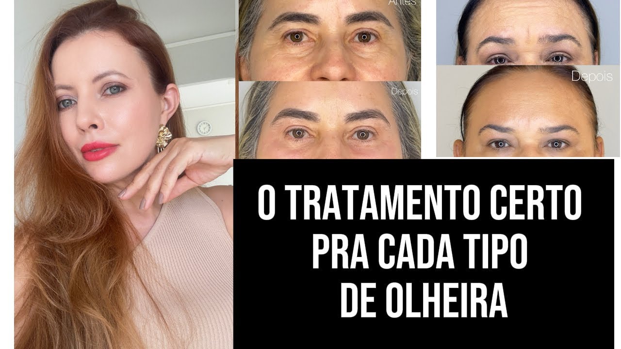 Olheiras Tem Solução: O Tratamento Certo Para Cada Tipo! #bioestimuladores #mounjaro 