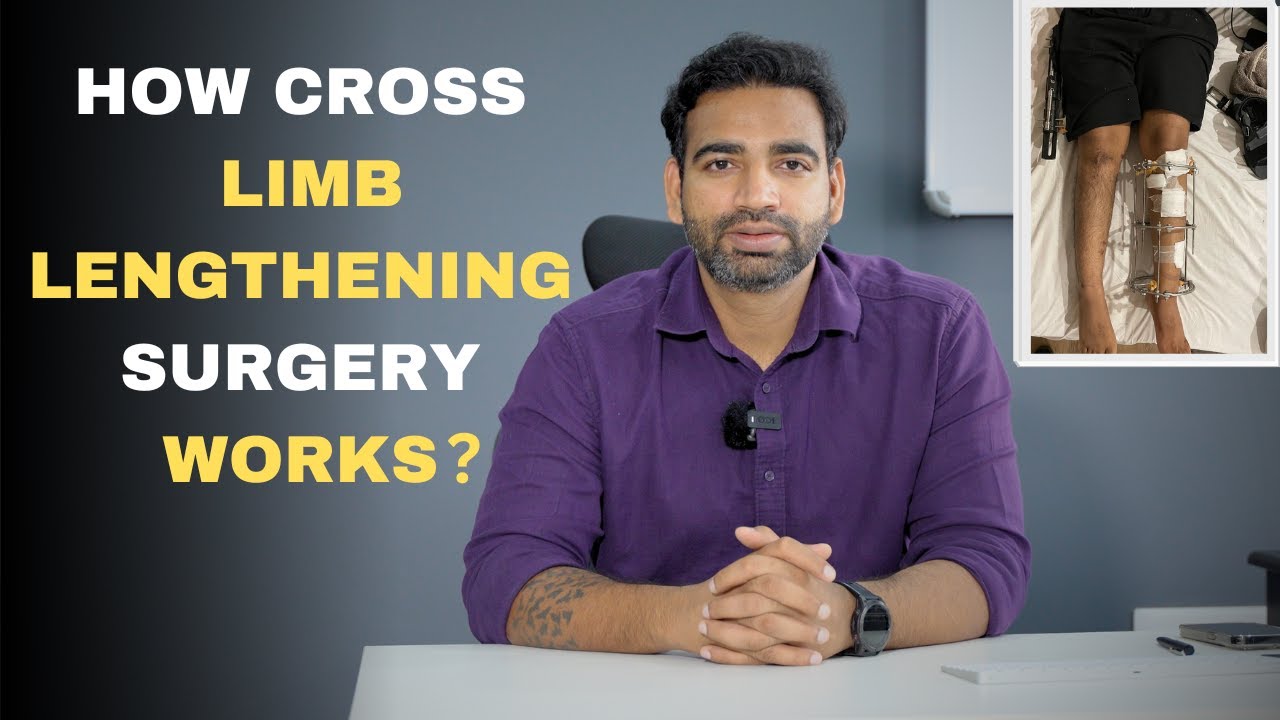 HOW CROSS LIMB LENGTHENING SURGERY WORKS ? #limblengtheningsurgery #heightincreaseinfo