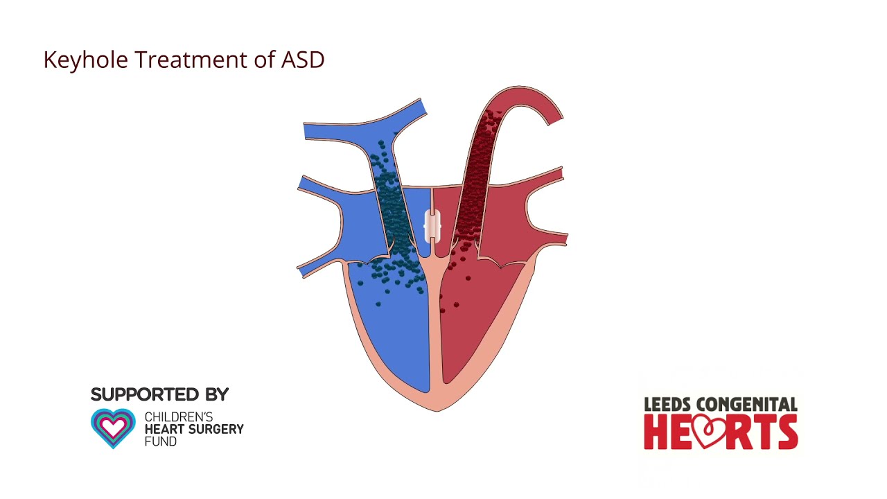 Atrial Septal Defect and Keyhole Treatment